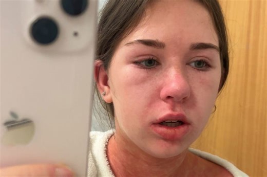 Teen who 'had flu' became unrecognisable thanks to 'kissing disease'