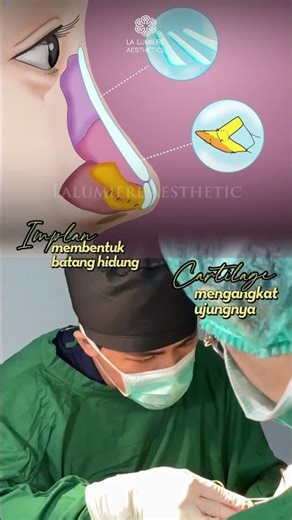 Hidung Mancung dengan Instan | Rhinoplasty - La Lumiere Aesthetic
