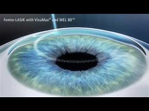 LASIK Procedure Animation