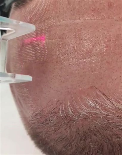 Tratament laser CO2 fracționat alături de echipa Dermisana! Vă așteptăm cu drag 💙 🔹 Beneficii principale: 1. Îmbunătățește textura pielii – Netezește pielea, reduce aspectul porilor dilatați și conferă un aspect uniform. 2. Reduce ridurile fine și medii – Prin stimularea colagenului, pielea devine mai fermă și mai elastică. 3. Estompează cicatricile – Foarte eficient pentru cicatrici post-acneice sau alte tipuri de cicatrici superficiale. 4. Tratează petele pigmentare și semnele de îmbătrânire
