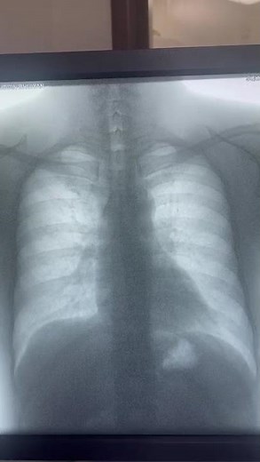 Diaphragm fluoroscopy/ Sniff test