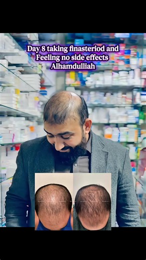 Day 8 of Finasteride: No Side Effects Yet