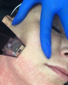 This state-of-the-art RF micro-needling treatment penetrates deep into the skin and fat, morphing the aging face by tightening and smoothing the skin into a sleek appearance. This treatment works on all skin types and skin tones. Patients in their mid-late 20’s & 30’s can start skin tightening treatments to delay and prevent the process. Tight skin is in! For patients over 40 or those who already experience sagging skin, we recommend a series of Morpheus treatments to lift and firm the skin. Thi