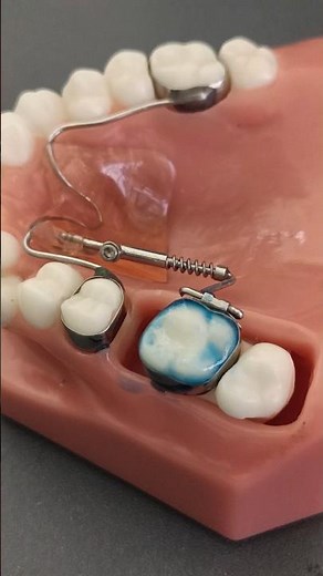 Fixed molar band appliance for orthodontic #dentist #dentalartistry #orthodontist #teeth #dentist