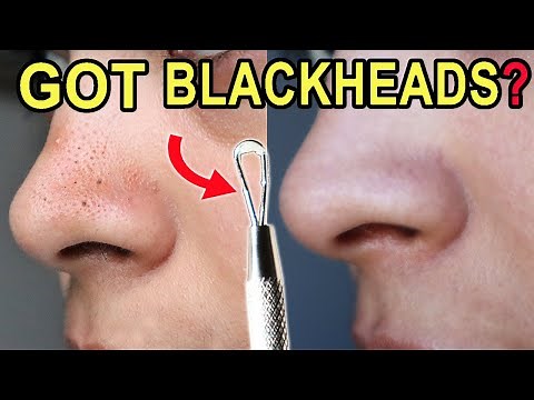 How I Clean Congested Pores on the nose [you should have one at home!]