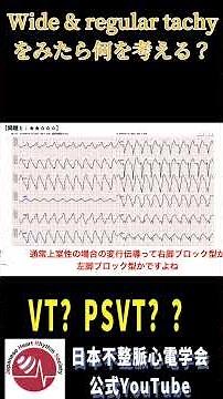 VTとSVT #心電図 #不整脈