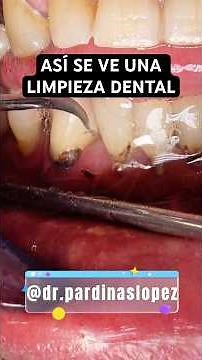 Así se ve una LIMPIEZA BUCAL profesional o PROFILAXIS PERIODONTAL