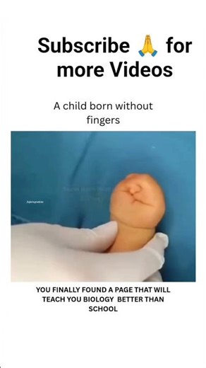 “How Amniotic Band Syndrome Affects a Baby’s Limbs”