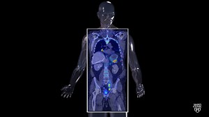 New imaging technology aids in prostate cancer diagnosis, treatment - Mayo Clinic News Network