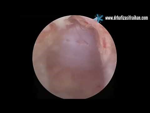 Sometimes foraminotomy is enough. See the beauty of UBE.