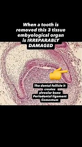 DID YOU KNOW ??? the alveolar bone - periodontal ligament and cementum all originate embryologically from the dental follicle. This basically mean that these 3 tissues are supposed to operate together in health - the bone is maintained by the ligament tension and the cementum joins the ligament to the root of the tooth. When a tooth is removed this 3 tissue ‘organ’ is irreparably damaged . The bone loss begins Patients who receive dental prostheses before the age of 60 will almost certainly expe