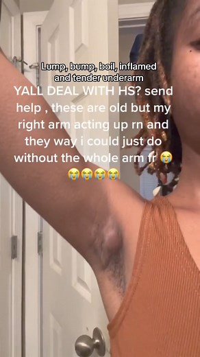 1K views | How to heal a flare up, lump, bump or boil under your arm #skinissues #hidradenitis #flareups #skincare | Mymagichealer | Facebook