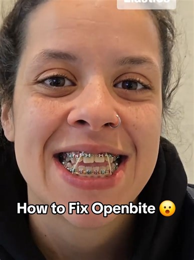 How to Fix Open Bite with Anterior Box Elastics