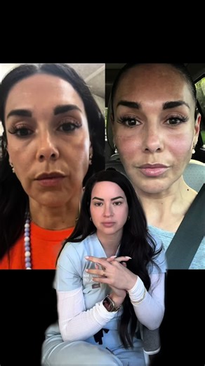 Transform Your Skin with Sculptra: Unique Results