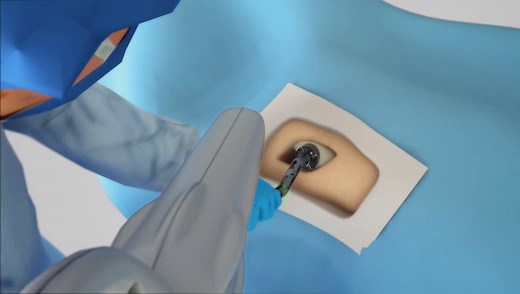 MAKO机器人工作视频