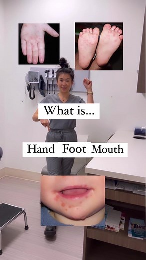 Hand, foot and mouth disease (HFMD) is a common, and very contagious, viral infection. It can be caused by several different viruses, but the most common is the Coxsackie virus. HFMD mostly affects children under the age of 5, but it can occur at any age. It most often occurs in the summer and fall. ✳️What Are The Symptoms Of HFMD? It takes about 3-6 days for symptoms to appear after you are exposed to HFMD. It usually starts out with a fever, runny nose and sore throat. Then a rash with tiny bl