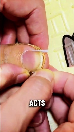 Fast & Easy Ingrown Toenail Relief