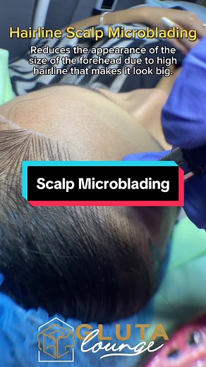 Hairline Scalp Microblading Procedure for Forehead Reduction