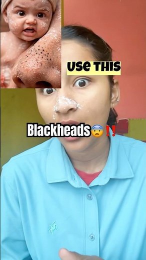 Blackheads & upper lip hair removal #youtubeshorts #trending #skincare #glowingskin #blackheads #ai