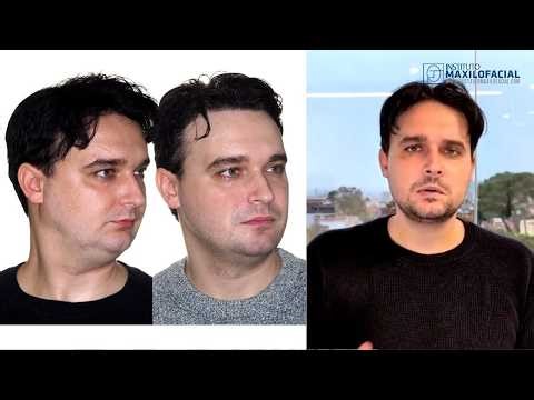 Bimaxillary Surgery Case #187 | Correction of Class II Maxillo-Mandibular Retrusion