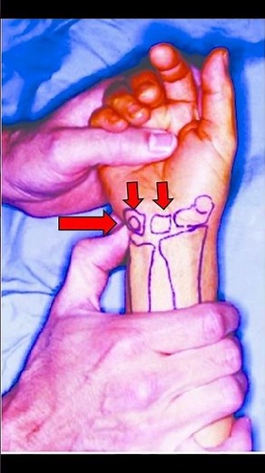 🖐️ Lunotriquetral Compression Test | Wrist Pain Exam #meded #ortho #physio #ATC #medicaleducation