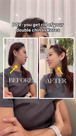 justjoanne fan 安安 on Instagram: "finally got my jawline SNACHED. no brusing, immediate results DAFUQ! 🤨😩 📍CLINIC: Eraser Clinic, Sinsa Gangnam Seoul I got introduced to the Tune Liner which I haven’t seen anyone else else talk about it is a bit pricier than the popular inmode & Shrunik procedure, but I was most worried about those because of the bruising and I felt like it would be really harmful to the eczema on my neck, but this one as you could see literally. no. damag