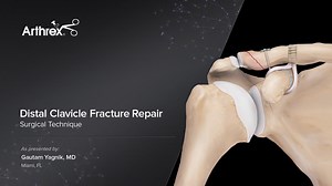 Distal Clavicle Fracture Repair