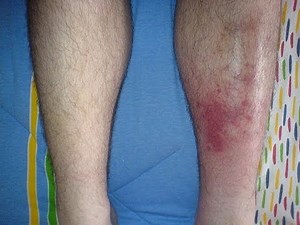 Cellulitis - Do Treatments Work? Symptoms