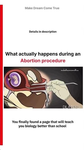 🤰🏻 What Actually Happens 💊 During an Abortion procedure 👩‍⚕️ | MDCT
