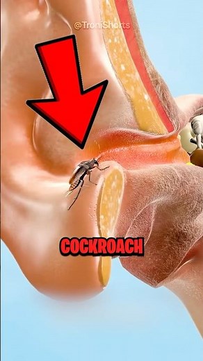 How To Remove Cockroach From Ear! 😱