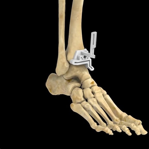 Vantage Ankle PSI Implant Surgical Animation