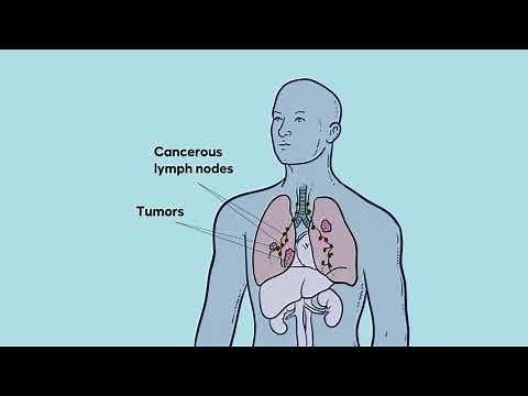 Non-small Cell Lung Cancer Explained