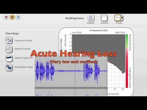 Hearing Loss - What it Sounds Like to Live This Way