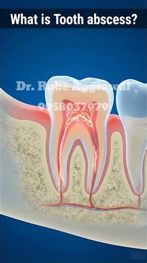 ⚠️ TOOTH ABSCESS CAN BE DANGEROUS – DON’T IGNORE THE PAIN!