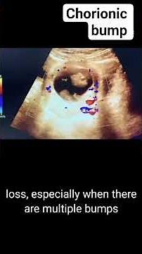 Chorionic bump on ultrasound #radiology #pregnant #ultrasound #pregnancyscan #baby