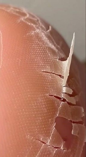 “Deep Heel Callus Peel | Extreme Dead Skin Removal 4K” #satisfying