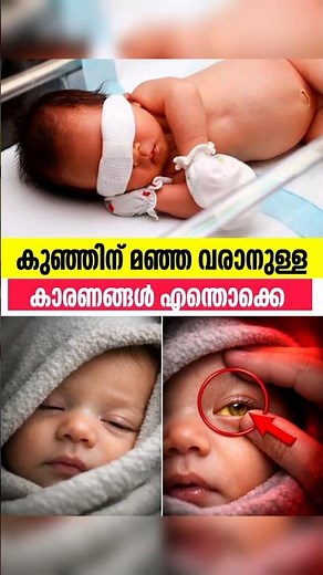 Newborn jaundice-Reasons