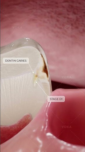 ¿Qué es la caries dental y cómo se desarrolla? Explora la odontología en 3D