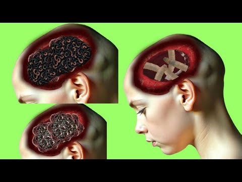 Extreme Brain Worm Infestation ASMR | Deep Parasite Removal Animation #asmranimation #animation