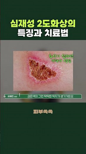 Characteristics and Treatments for Deep Second-Degree Burns
