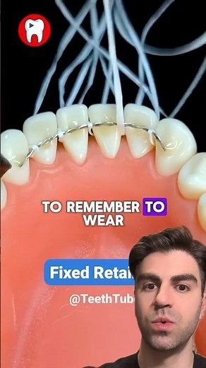 Why You Need a Fixed Retainer (Dental Health 101)