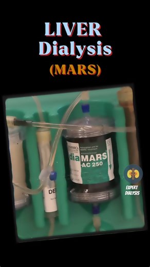 Expert Dialysis on Instagram: "📝MARS in Dialysis: A Lifeline for the Liver When the kidneys and liver are in trouble, traditional dialysis isn’t enough. That’s where MARS (Molecular Adsorbent Recirculating System) steps in. This advanced therapy helps remove protein-bound toxins that regular dialysis can’t touch — giving the liver a fighting chance to recover or stabilize. Used in cases like acute liver failure, hepatic encephalopathy, and drug toxicity, MARS is a bridge to transplant or healin