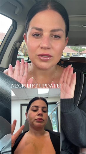 6 WEEKS 4 DAYS POST OP!! (neck lift with @Dr. B) #necklift #facelift #lowerfacelift #plasticsurgery #cosmeticsurgery #fy #fyp #beforeandafter #postop #recovery #swelling #jawline