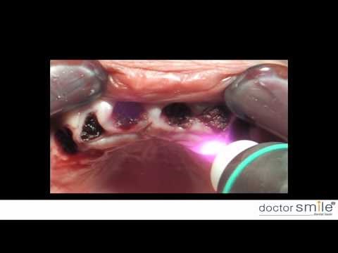 Doctor Smile Dental Laser Biostimulation