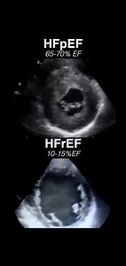 Echocardiogram: Heart Failure with preserved Ejection Fraction (HFpEF) vs Heart Failure with reduced Ejection Fraction (HFrEF). ___________________________________ #radiology #cardiology #usmle #medschool #medstudent #echocardiogram #cardiologist #cardiologia #heartfailure #hearthealth #medicalstudent #medicalschool #MedEd | MEDspiration