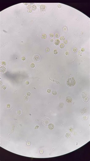Understanding Urine Analysis and Microscopy