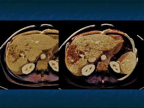 CT Evaluation of Hepatic Masses: A Focused Approach to Signs and Enhancement Patterns - Part 6