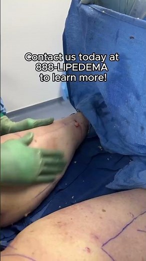 How does Manual Lipedema Extraction™ work?