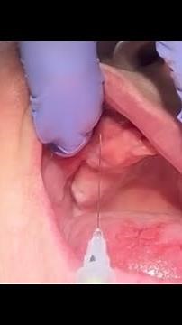 Infraorbital Nerve block Intra oral method