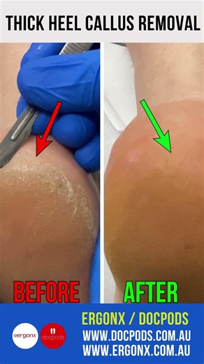Satisfying Thick Heel Callus Removal by Podiatrist #FootCare #CallusRemoval